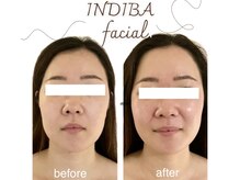 インディバ ベース(INDIBA BASE)の雰囲気（高周波が加齢の原因にアプローチ！ハリ艶UPで内側から元気な肌へ）