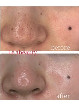 レアビューティー(Le'a beauty)の写真/お肌を綺麗にしたい方必見！《医療機関と提携するサロン》一人一人に合った施術をお悩み別にご提案します◎