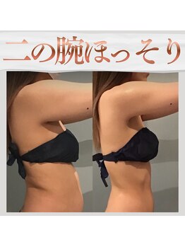 ボディエステティック アクアオーラ 富山店の写真/ノースリーブを華奢に着こなす!二の腕&ハミ肉ケアで、華奢見えシルエットへ導きます☆