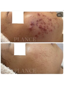 プランス 恵比寿店(PLANCE)/恵比寿/エステ/ニキビケア
