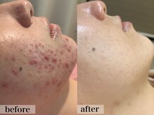 エステサロン ジョアアンジェ(joie ange)/コモデックス　半年間