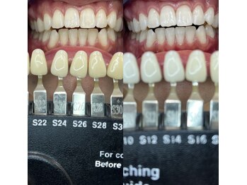 トウキョウスワーズ 池袋店(TOKYO SWRS)/#ホワイトニング #池袋 #渋谷