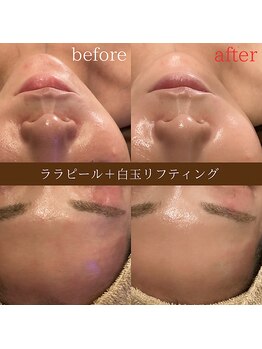 ディースズ(D.suzu)/ララピール×白玉リフトUP&鎮静