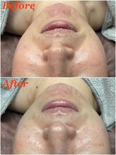 ティアーナ(Tiaana)/ララピール施術直後