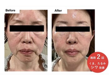 ミセル 尾道店(MYTHEL)/エレクトロポレーション効果