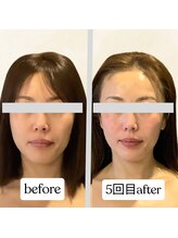 ビーサロン(B-salon)/よりシャープな小顔に