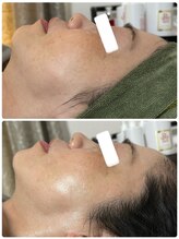 ビジュープラス 幸手店(Bijou+)/シワ・毛穴ケア