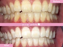 エクシアホワイトニング 札幌中島公園店/Before After［ホワイトニング］