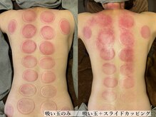 ニカ(Nica)/【吸い玉+スライドカッピング】