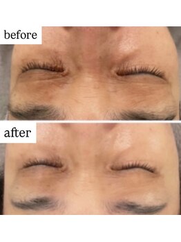 エン(O'en)/目元のくすみ改善