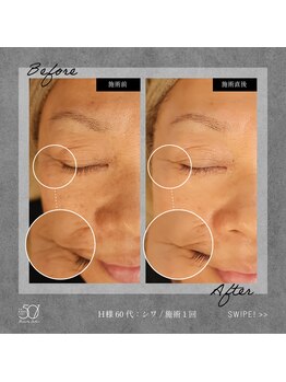 ゴーマルイチ(501)/プラズマシャワー Before/After