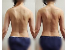 ソアン(Soan)/カチカチの肩・背中もスッキリ！