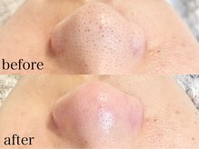 アイラッシュサロン ココ(CoCo)/毛穴エクストラクション