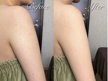 スリリアン 銀座/★ニキビ劇的ビフォーアフター★
