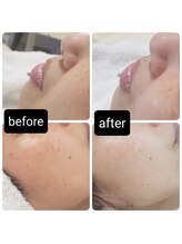 ソラ(sora)/ハイドロ・毛穴の症例★