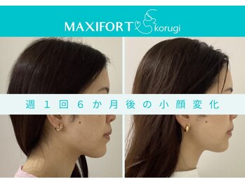 マキシフォート 名駅店(Maxifort)/週1 回6ヶ月後の小顔変化