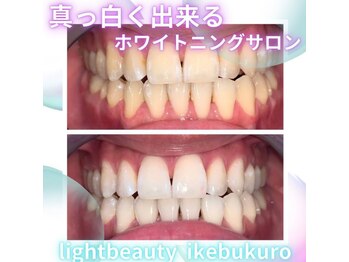 ライトビューティー 池袋店(LightBeauty)/症例写真