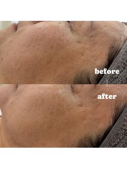 ミア(Mia)/ゆるんだ毛穴、ピーン♪