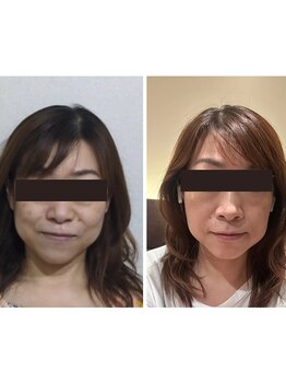 ミヤビ(miyabi)/小顔矯正