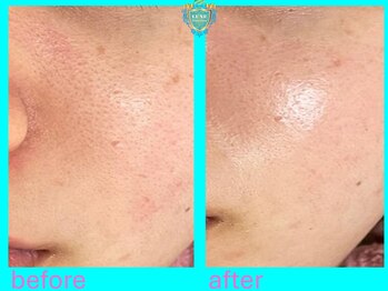 リュクス(LUXE)/ビフォーアフター