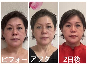 アクアナチュラ(ACQUANATURA)/お顔スッキリ若々しい印象に!