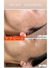 リツイート(ReTweet)/韓国NO1ララピール