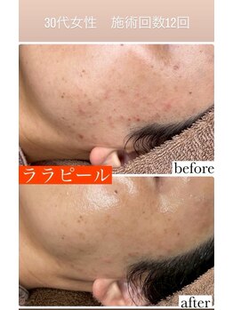 リツイート(ReTweet)/韓国NO1ララピール