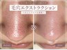 【毛穴詰まり/いちご鼻】角栓ごっそり/毛穴エクストラクション