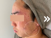 グリーンピール エルモナ(GREENPEEL ELMONA)/【グリーンピール５Days】