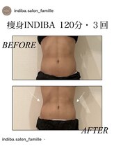 ファミーユ 新宿店/【痩身インディバ】