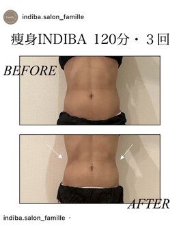 ファミーユ 新宿店/【痩身インディバ】