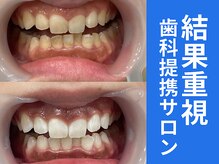 ホワイトニングカフェ 奈良新大宮店(WhiteningCafe)/◎歯のホワイトニング施術写真◎