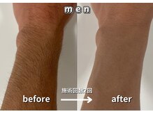 キュー(cue)/【メンズ】「腕脱毛」施術事例
