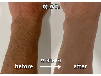 キュー(cue)/【メンズ】「腕脱毛」施術事例