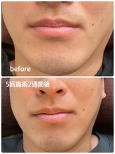 サンタ(santa)/髭脱毛before after