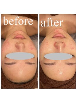 ディス イズ ミー エステティック(This is Me Aesthetic)/ニキビケアにはララピール