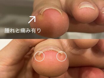 キラネイル アンド アイラッシュ by World Beauty(KIRA)/#新潟巻爪 #ペディグラス