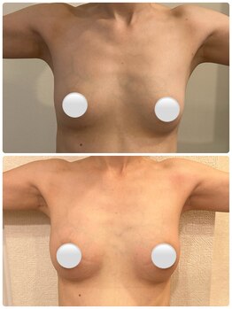 アイン 銀座(Ain)/バストアップ例　６