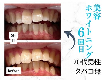 ルカノン(le canon)/自慢の歯を手に入れました(^^)　