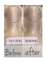 ツリービューティー(Tree Beauty)/★毛穴洗浄初回￥1000★