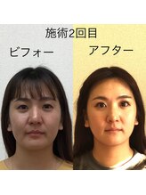 オズ六本木/六本木小顔矯正(正面)施術2回