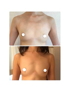 美人バスト 川崎店/バストアップ◇症例◇