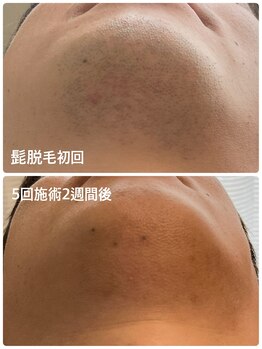 サンタ(santa)/髭脱毛before after