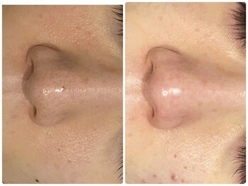 エステサロン ブレス 山形店(BLESS)/フェイシャル結果