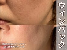 ポレ サロ(pore salo)/【ウィンバック｜たるみケア】