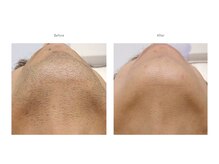 ココラボ(COCOLABO)の雰囲気（青ひげで悩まれてる方や、顔そりが面倒な方は是非、ヒゲ脱毛を！）