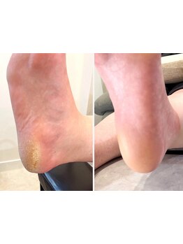 角質ケアができるサロン