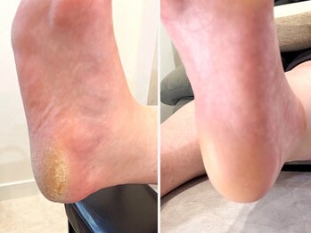 ドゥエ(doue')の写真/《大人気!フットジェル&角質ケア》大人可愛く彩られた足先とツルスべかかとで感動仕上がり◎魅せる素足に♪