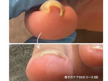巻き爪補正3回