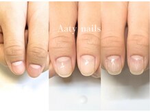 アーティネイルズ(Aaty Nails)/【深爪矯正】ハンド